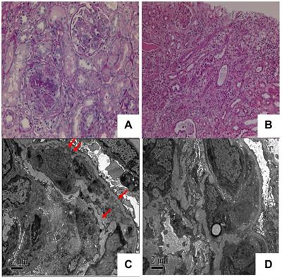 IgM kappa proliferative glomerulonephritis with monoclonal immunoglobulin deposition complicated with nocardiosis dermatitis: a case report and review of literature
